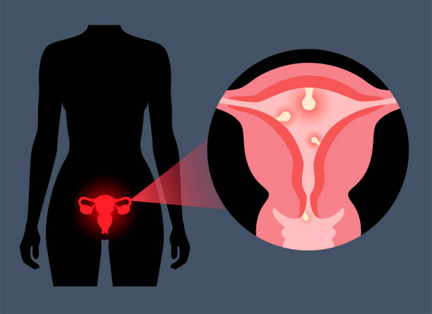 Иллюстрация женской репродуктивной системы с детальным изображением матки крупным планом с признаками инфекции.